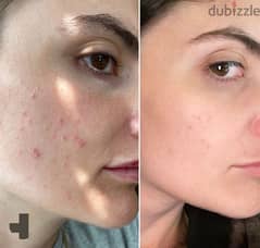pimple remover,, psoriasis remover