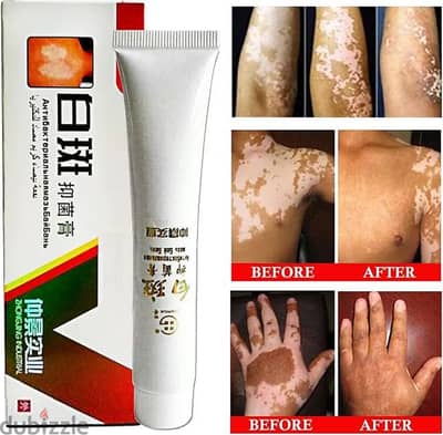 vitiligo treatment